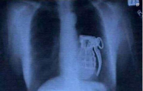 不作死就不会死，看看这些被人类搞进身体里的异物