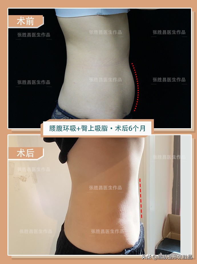 想要马甲线可以练出来吗,腰腹吸脂马甲线恢复过程