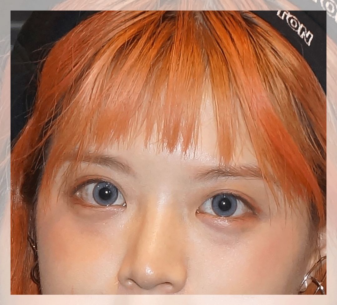 董氏奇穴一针治疗黑眼圈,熊猫针一针就能去掉黑眼圈吗