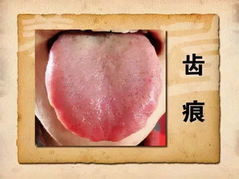 九大体质的诊断标准,什么指标诊断易栓体质