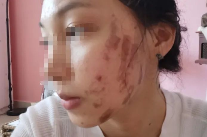 面部皮肤烫伤毁容图片,医院免费治疗毁容女孩