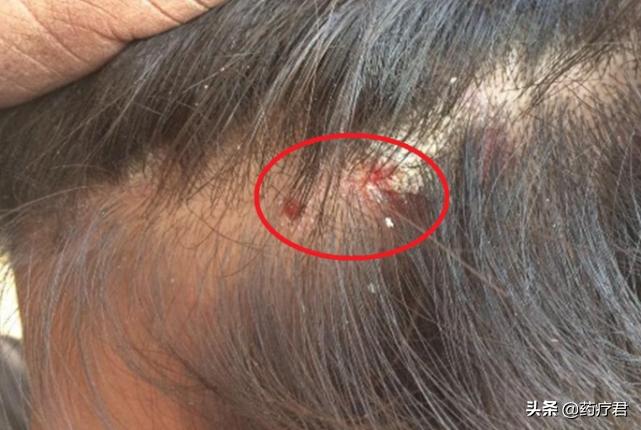 头皮痘痘一抠破就流很多血,头皮长痘痘摸上去痛怎么办