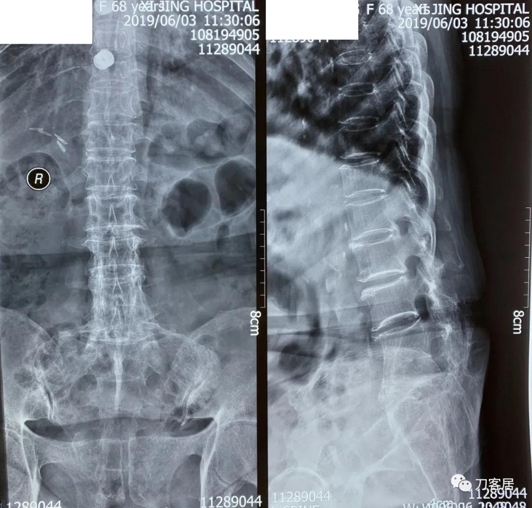 腰椎结核手术没有清病灶,腰椎结核术后不排气