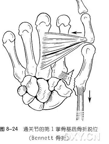 特殊骨折类型,特殊骨折体征