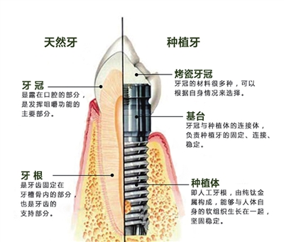 固定牙搭桥多少钱,固定桥修复牙齿价格