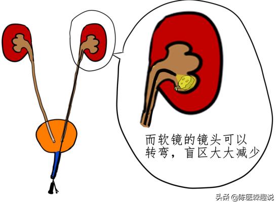 发现肾结石怎样治疗更好,发现肾结石怎么办