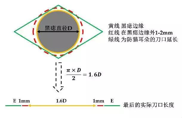黑痣预防性去除有必要吗,原来去除黑痣是如此简单
