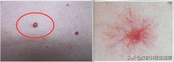 孕期长痘可以用的皮肤药,怀孕皮肤长斑长痘用什么护肤品