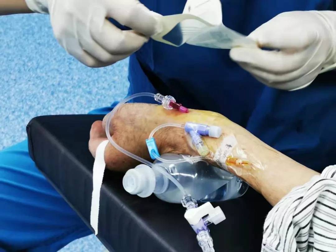 鐧惧瞾鑰佷汉楠ㄧ鎵嬫湳鎴愬姛,鐧惧瞾鑰佷汉楠ㄧ鎵嬫湳鎴愬姛妗堜緥