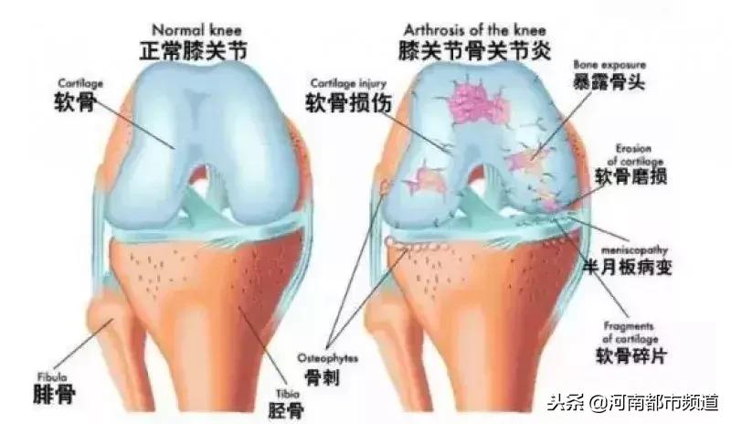 老人膝盖软骨磨没了最佳治疗方案,老年人膝关节软骨退化怎么办