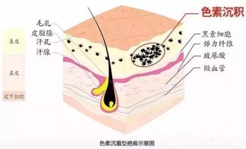 老公，我长痘痘了老公：多喝热水多喝水对痘痘真的好吗