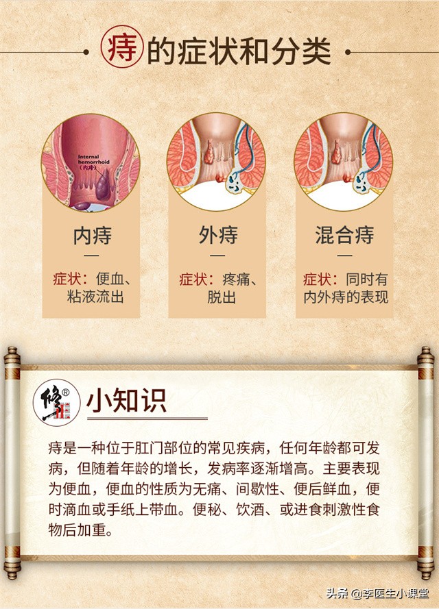 吃什么痔疮药能消痔疮肉球呢,怎么办才能使痔疮的小肉球消退