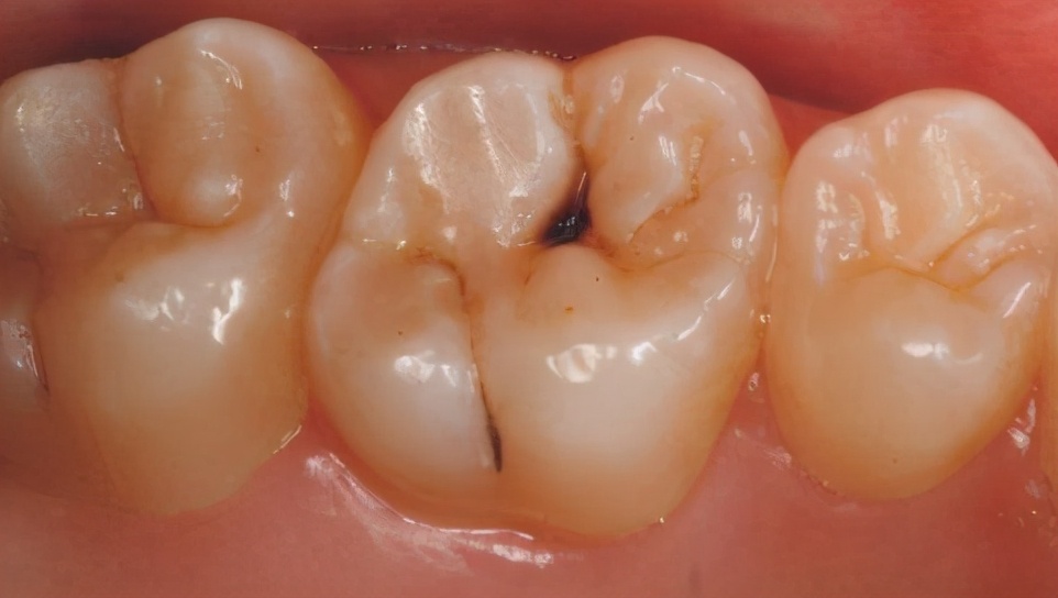牙齿有小黑点医生不处理直接补上,牙齿上有黑点不补牙怎么样解决