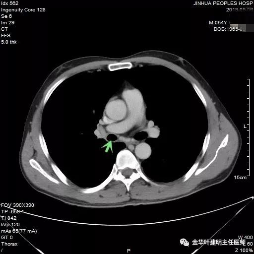 省级医院也漏诊?还好没耽误病情!我们予以行右中下叶袖式切除术