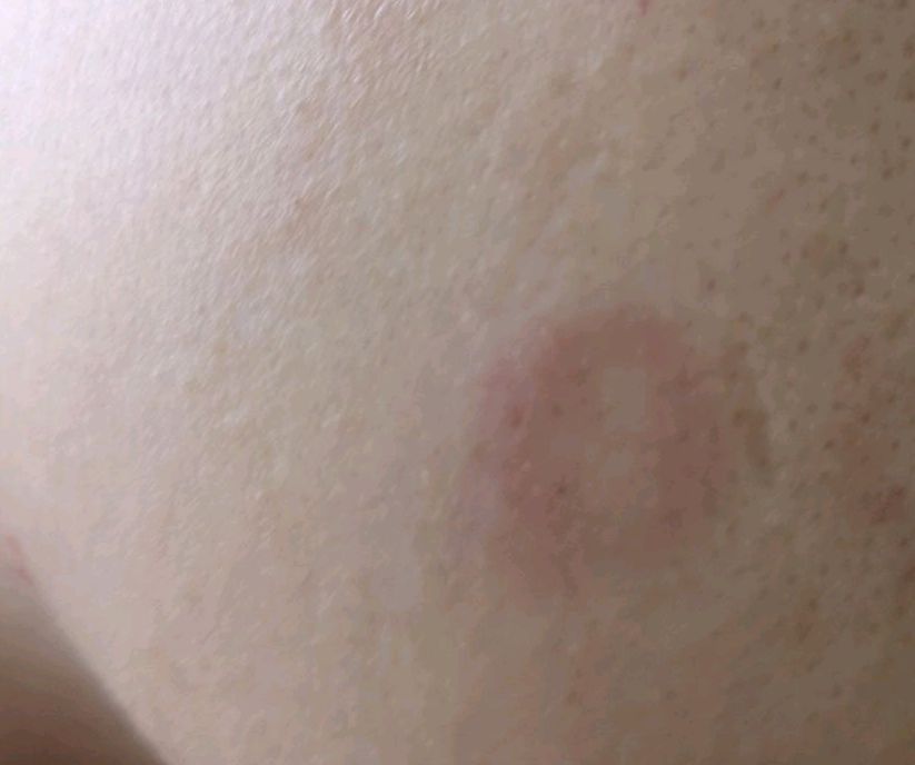 脸上有大的圆圈空心状红斑图,脸上圆圈状红斑