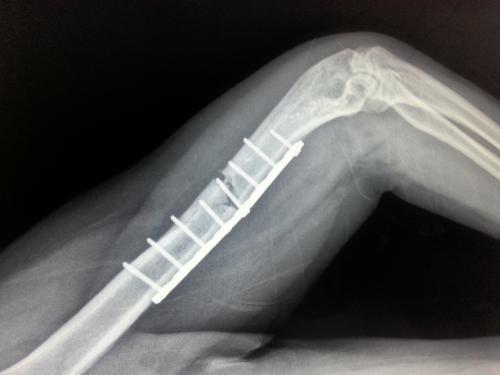 骨折后肿胀不能手术怎么办,骨折恢复过程中脚肿怎么办