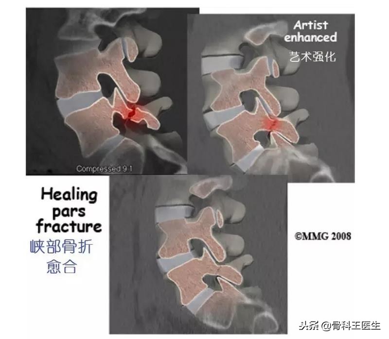 腰椎滑脱可以复位吗,第四腰椎向前滑脱1度可以复位吗