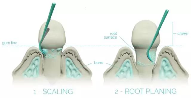 普通洗牙和舒适化洗牙有什么区别,一般洗牙和深度洗牙区别