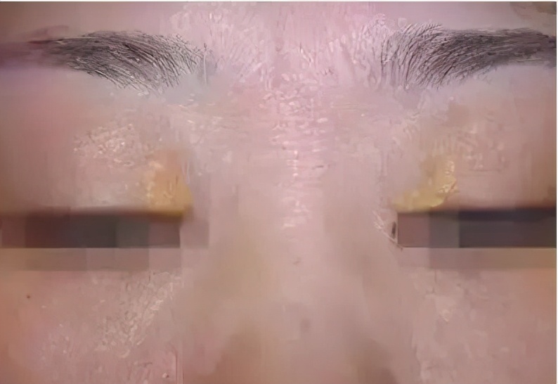 血脂高不高看这4个部位就知道,血脂偏高的4个信号