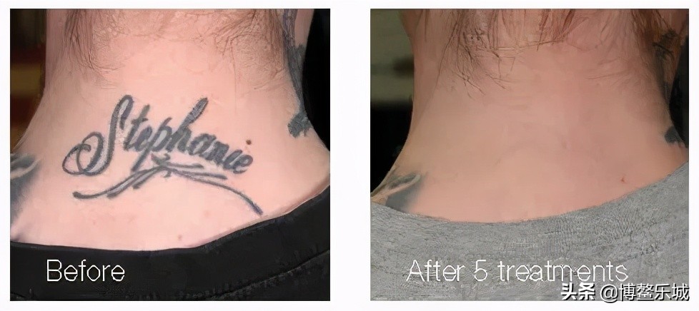 平价家用激光祛斑仪测评,世界顶级激光祛斑仪