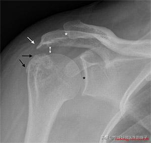 左侧肩膀疼痛预示十种病,哪些病可引起肩膀痛后背痛颈椎痛