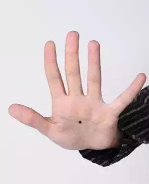 健康‖识别黑痣易癌变的位置