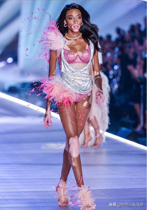 患白癜风的超模,有白癜风的国际名模