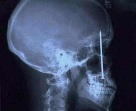 不作死就不会死,看看这些被人类搞进身体里的异物