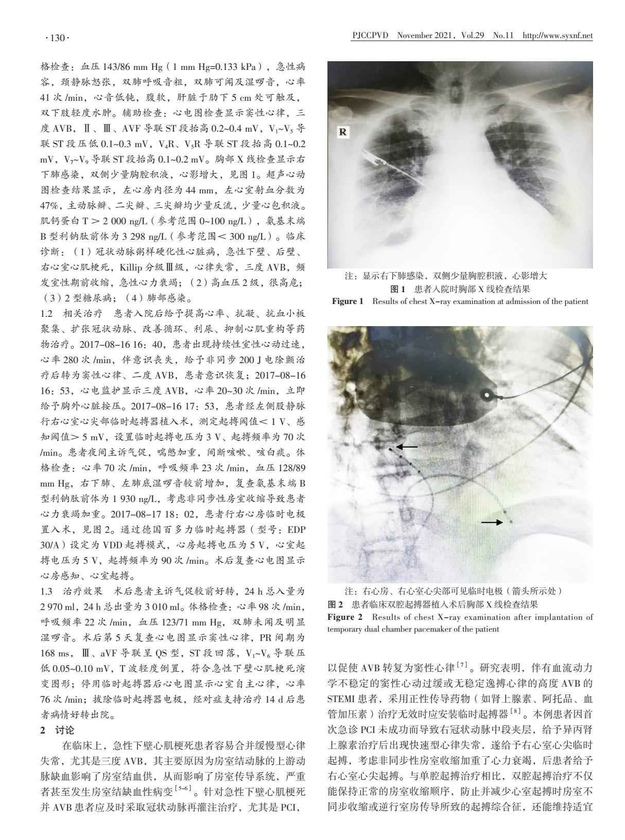 急性心肌梗死并三度房室传导阻滞后急性心力衰竭的治疗研究