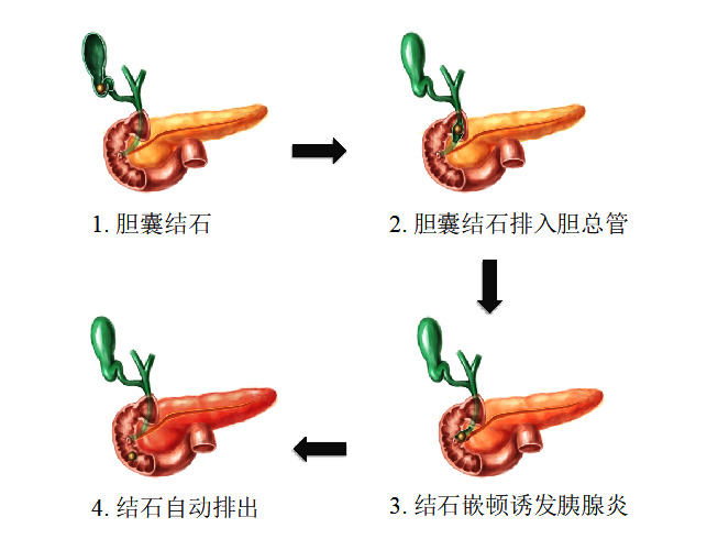 什么是胰腺炎？得了胰腺炎该怎么办？胰腺炎能留下后遗症吗？一篇文章消除您对胰腺炎的“胰”惑