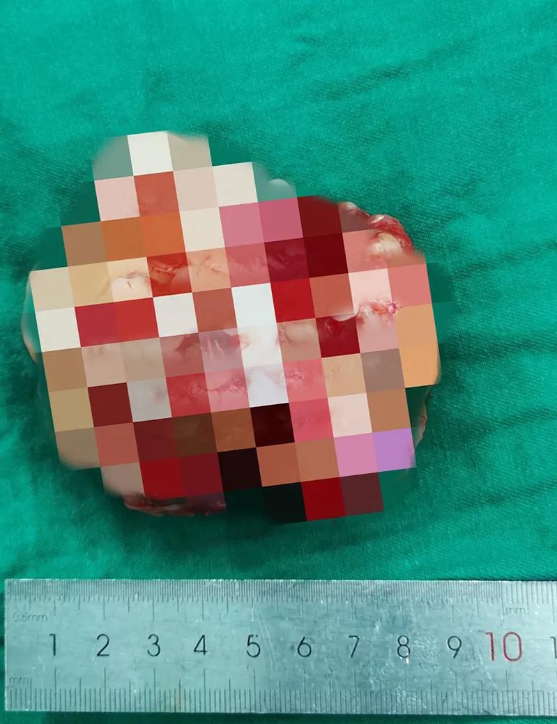 孩子胯骨处长了一个硬疙瘩,小孩胯部肉里长疙瘩怎么回事