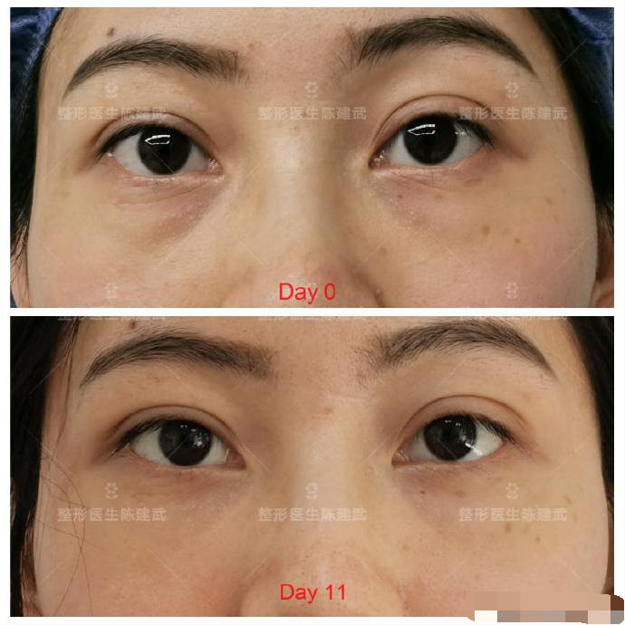 想做眼袋害怕翻眼,想做眼袋手术又怕失明