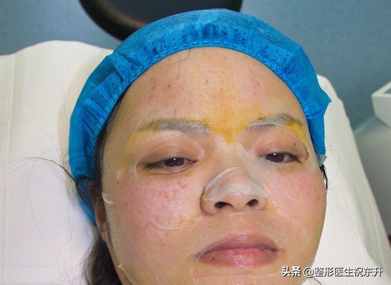 打水光针后的真实感受,水光针注射后1到7天的变化测评