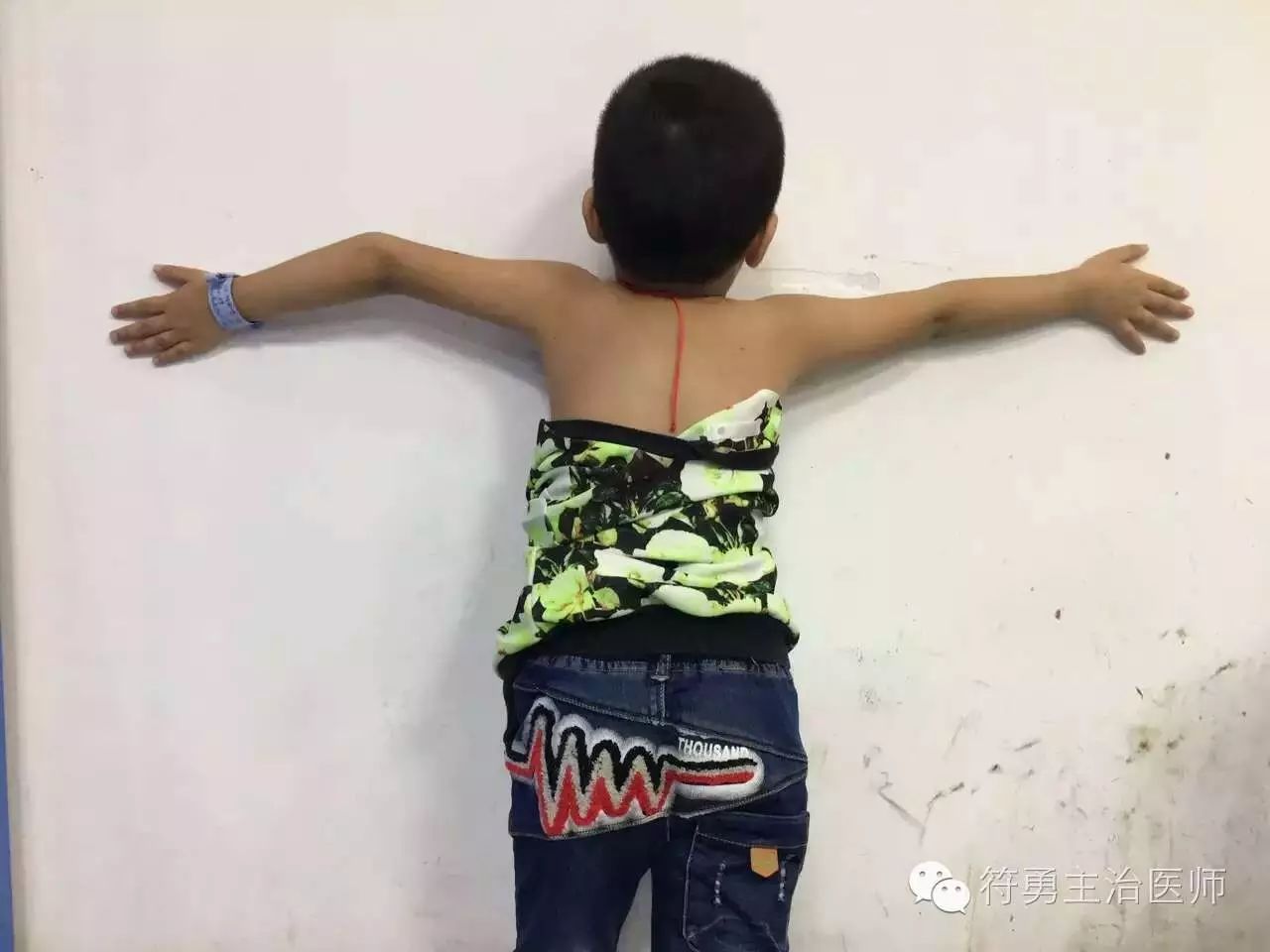 手臂肘内翻的手术效果,胳膊肘内翻矫正手术28年费用