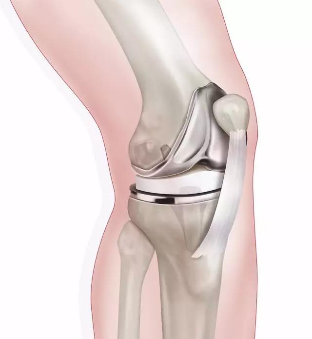 骨科专家提醒：治疗膝关节炎警惕十大误区