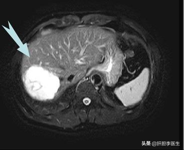 肝血管瘤3x2.5cm严重吗,体检发现肝血管瘤20*14mm