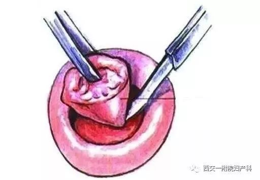 宫颈锥切手术后住院几天,宫颈锥切手术后饮食禁忌