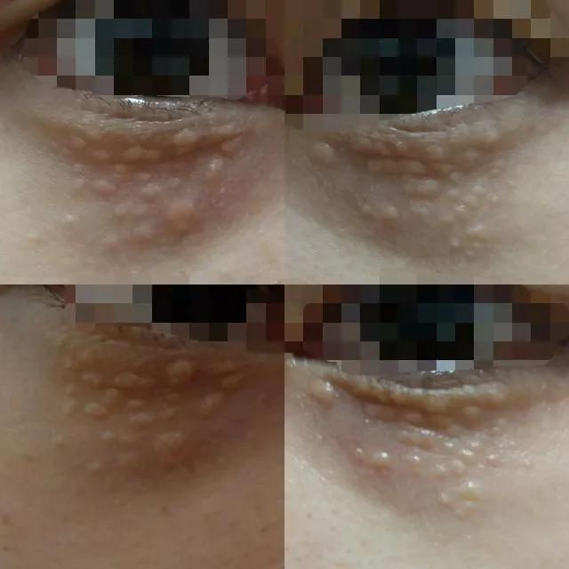 脂肪粒的形成原因以及消除方法,脂肪粒的形成原因以及去除方法