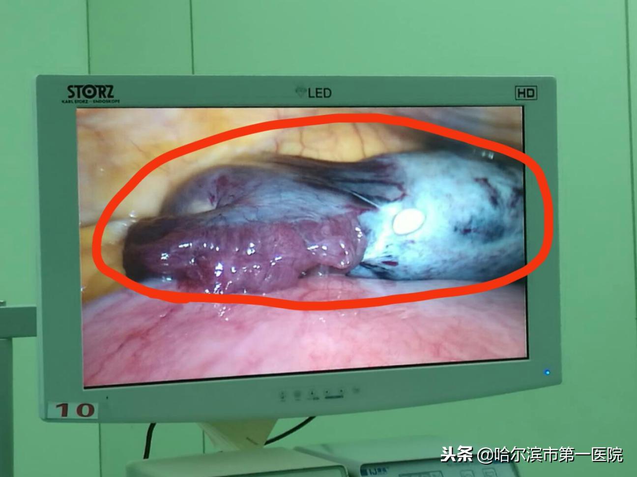 身怀六甲卵巢囊肿蒂扭转720°医生腹腔镜下保母子平安