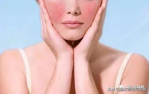 认识痘痘类型,玫瑰痤疮和激素脸哪个严重