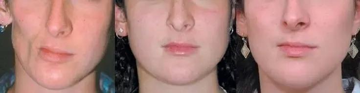 错颌畸形导致的脸歪矫正,矫正偏颌是什么原因导致的