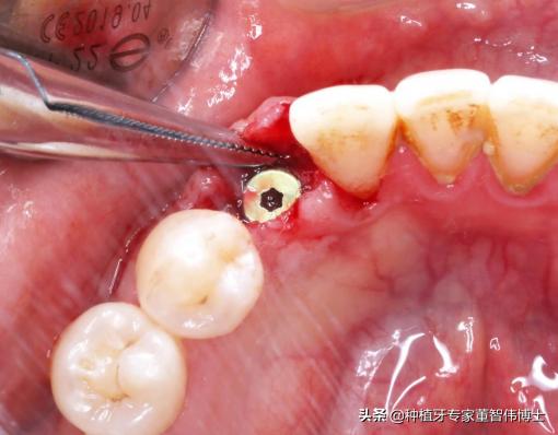 全冠修复与种植区别,全口即刻种植修复详细流程介绍