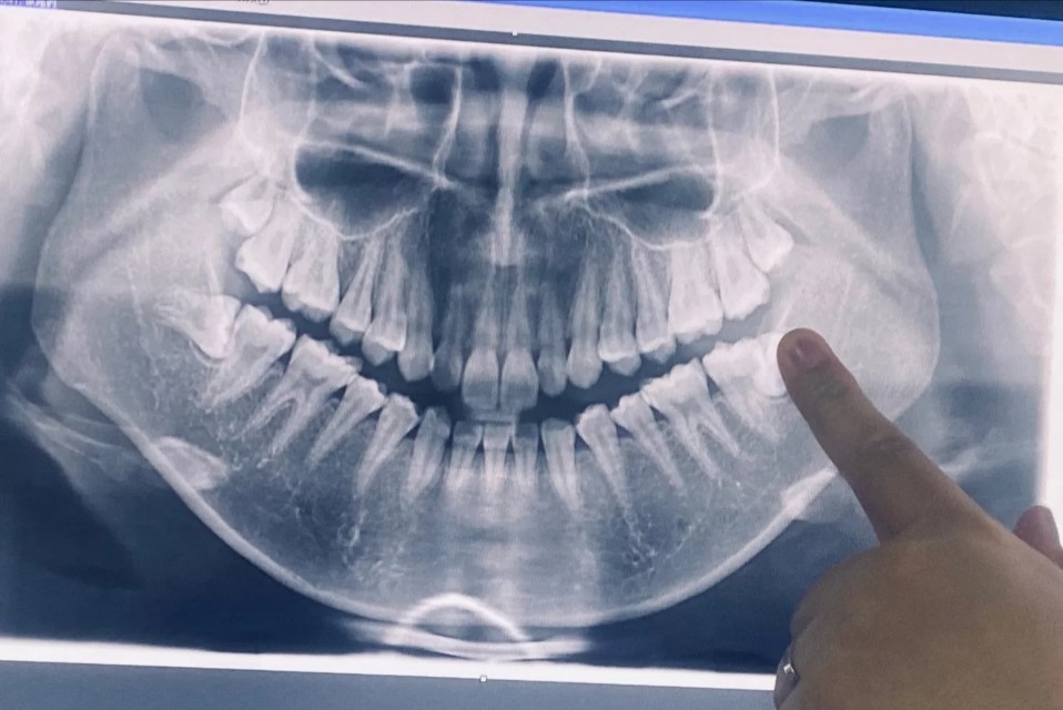 杭州口腔拔牙,杭州口腔嘉兴分院拔牙