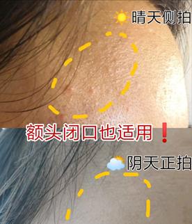 脸上长闭口怎么办教你正确去闭口,去闭口最简单的消除方法