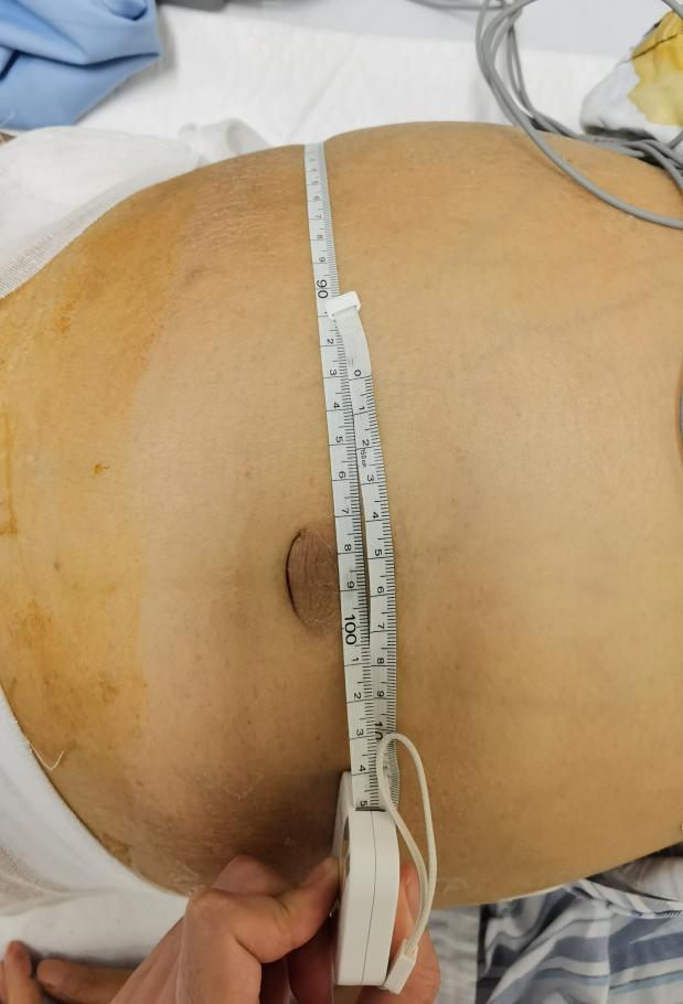 肚子突然变大像要撑破了肚皮,肚子大的像怀孕一样有胀气