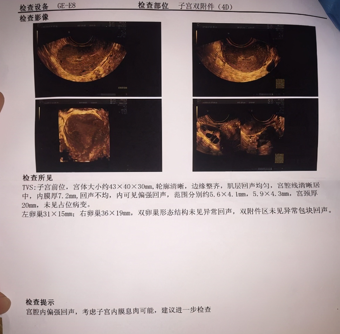 子宫内膜息肉诊刮多久可以怀孕,子宫内膜息肉手术后还是没怀孕