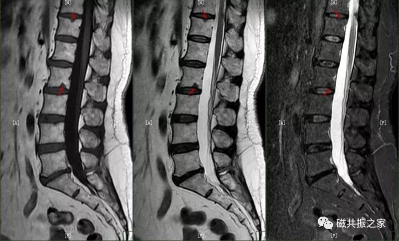 腰椎有哪些病变,腰椎病变有几种