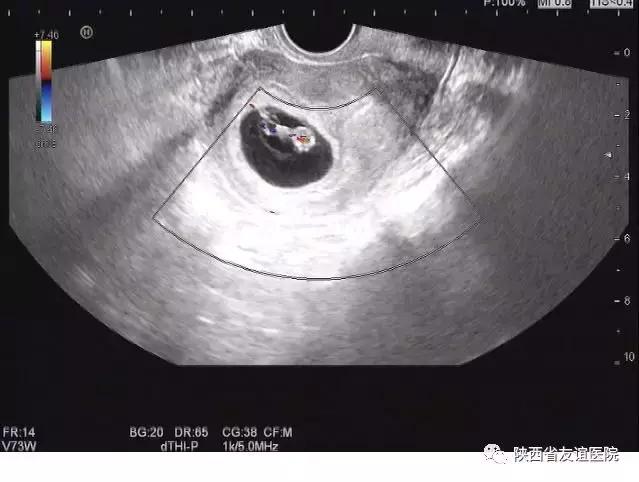 孕妇超声检查不良影响,孕妇超声检查的几大误区