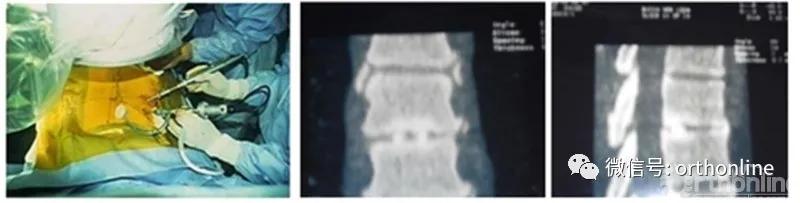 从“脊髓镜”谈到UBE/BESS:追溯脊柱内镜演化史(上)