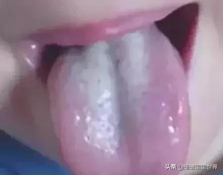 积食引起的舌苔白厚怎么办,小儿积食舌苔白厚吃啥药